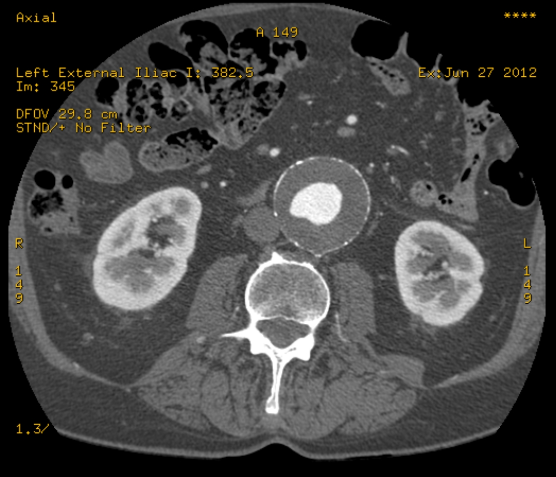 Infrarenal abdominal aortic aneurysm and arc of Riolan | Image ...