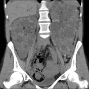 Autosomal dominant polycystic kidney disease, Radiology Reference Article