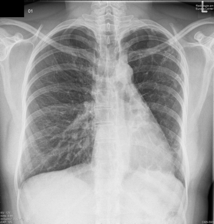 Swyer-James syndrome | Radiology Reference Article | Radiopaedia.org