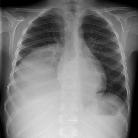 Ganglioneuroma | Radiology Case | Radiopaedia.org