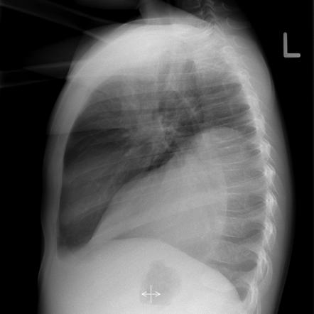 Ganglioneuroma | Image | Radiopaedia.org