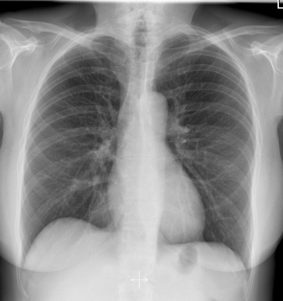 Normal Chest X Ray Images