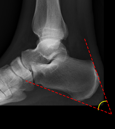 Fowler-Philip angle | Radiology Reference Article | Radiopaedia.org