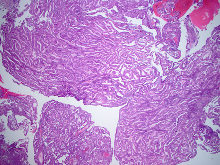 Endometrioid adenocarcinoma of the endometrium | Radiology Reference ...