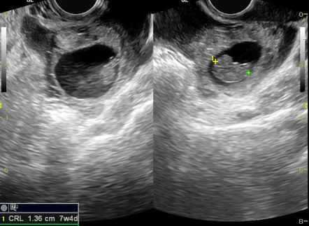 Ectopic pregnancy: tubal | Radiology Case | Radiopaedia.org