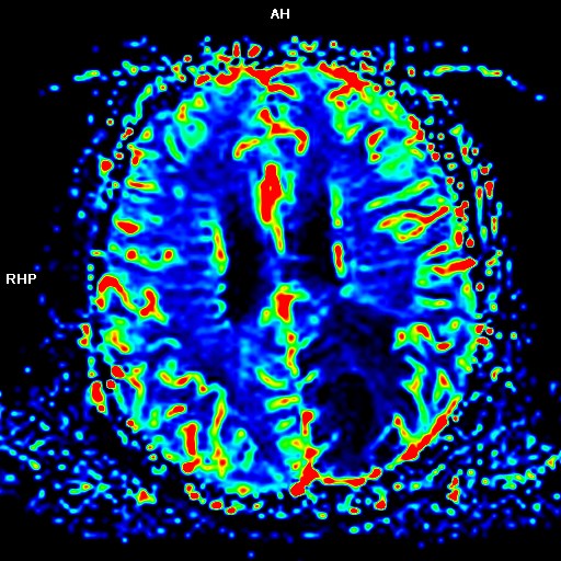 Cerebral toxoplasmosis | Image | Radiopaedia.org