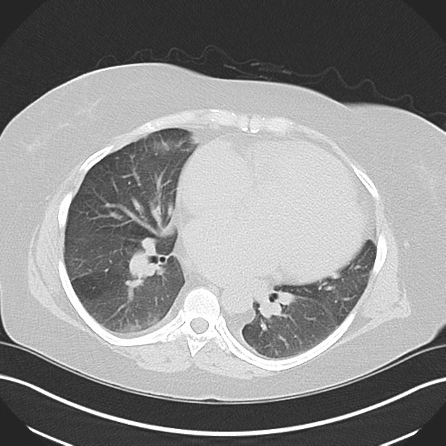 Mosaic attenuation pattern in lung | Radiology Reference Article ...