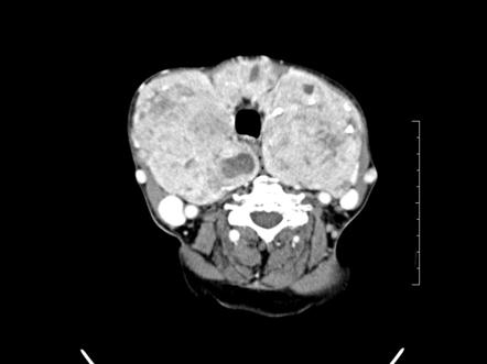 Multinodular Goiter Radiology Reference Article Radiopaedia Org