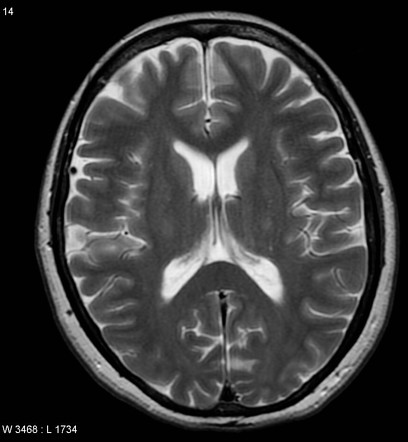 Playlist 'Primer - Neuroradiology - Degenerative and White Matter ...