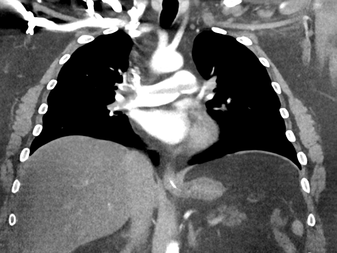 Pulmonary embolism - with saddle thrombus | Image | Radiopaedia.org