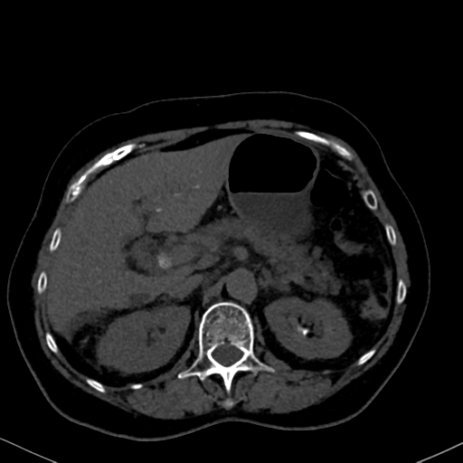 Cholecystitis - Obstructive Choledocholitiasis (CT Intravenous ...