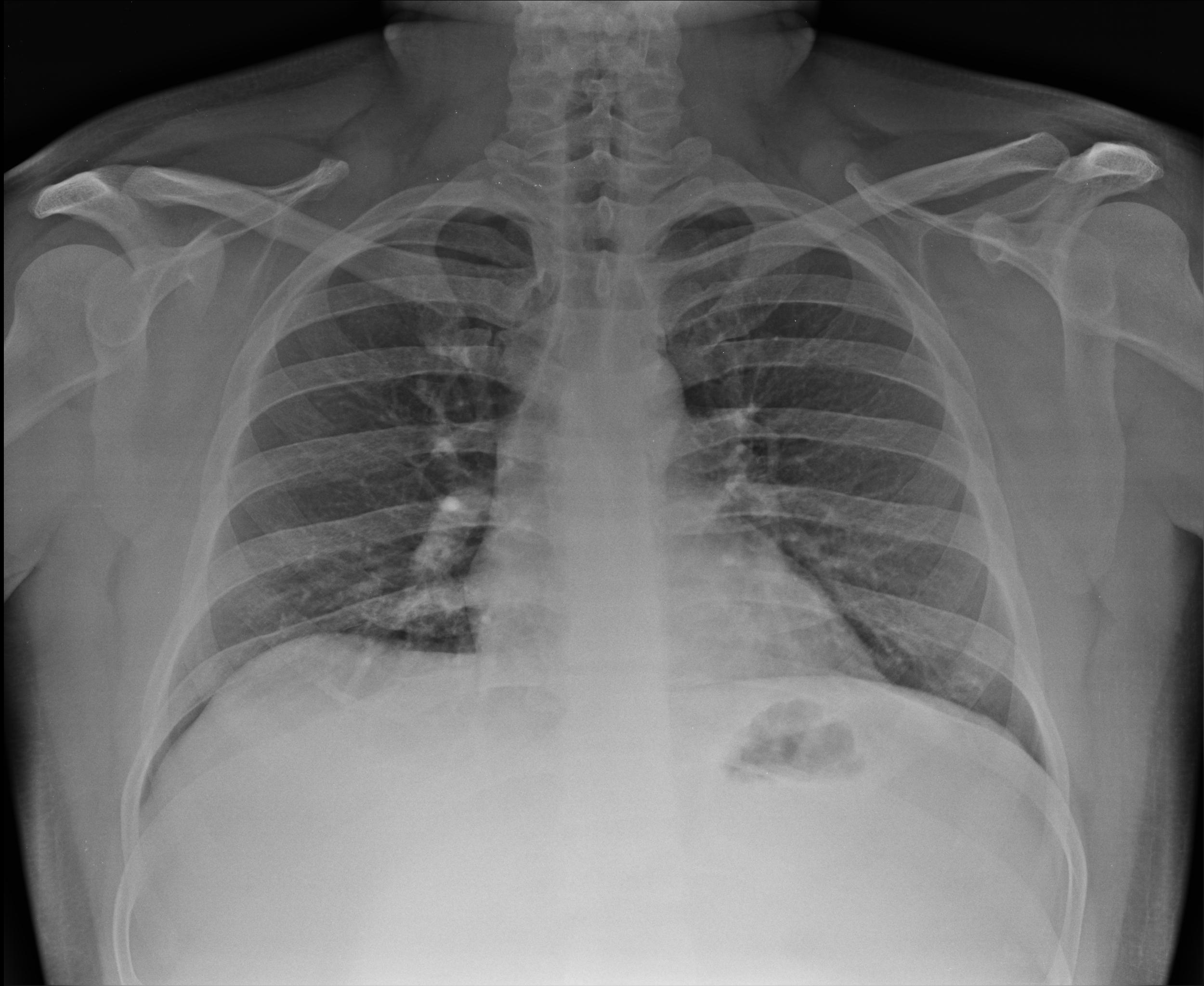 Manubriosternal joint subluxation | Image | Radiopaedia.org