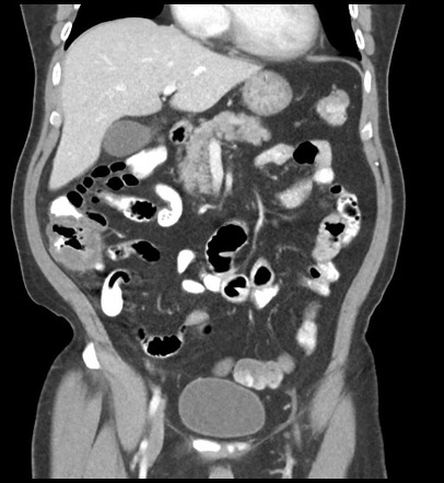 Neutropenic colitis | Radiology Case | Radiopaedia.org