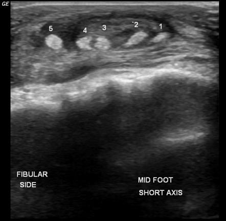 Accessory muscles of the ankle | Radiology Reference Article ...