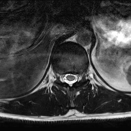 nitrous toxicity radiopaedia