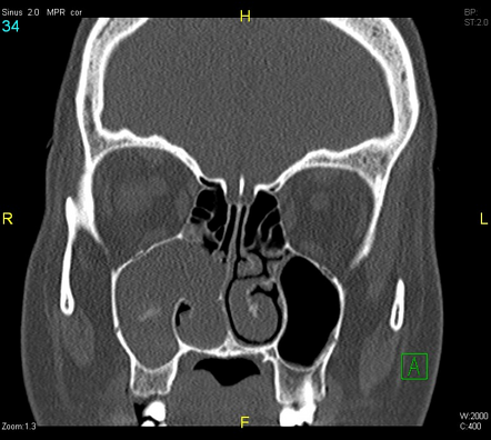 Antrochoanal polyp | Radiology Case | Radiopaedia.org