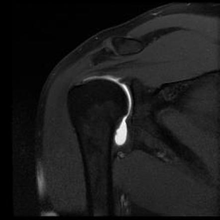 Partial interstitial tear of distal supraspinatus tendon | Image ...