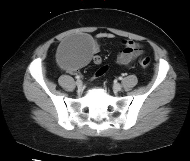 Low-grade appendiceal mucinous neoplasm | Radiology Reference Article ...