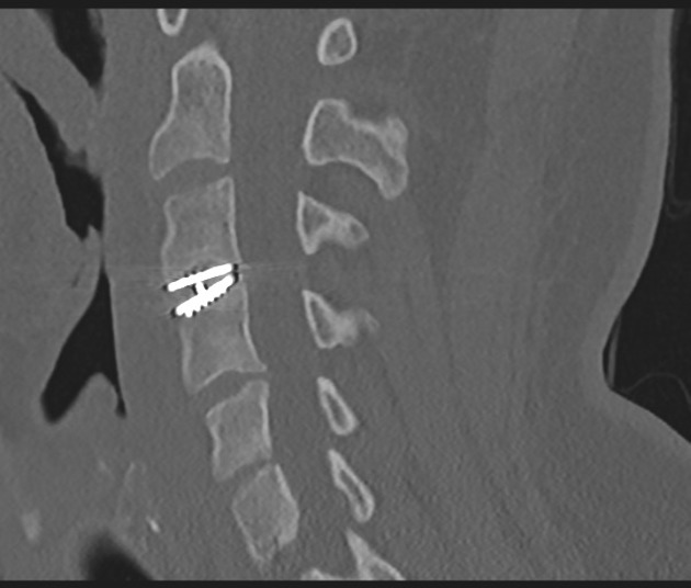 Cervical Disc Replacement Radiology Case Radiopaedia Org