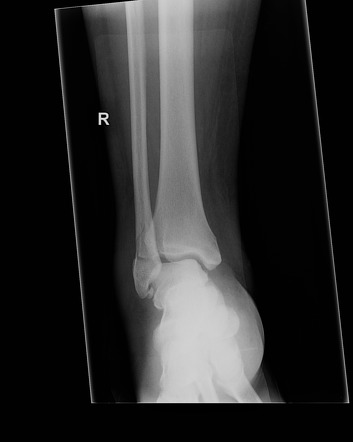 Ankle Fracture - Weber B | Image | Radiopaedia.org