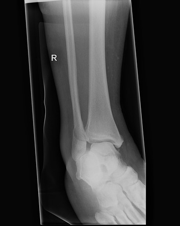 Ankle Fracture - Weber B | Radiology Case | Radiopaedia.org