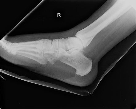 Ankle Fracture - Weber B | Image | Radiopaedia.org