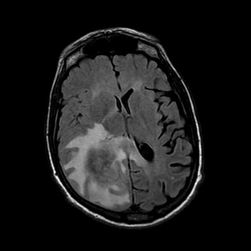 Primary CNS lymphoma in HIV/AIDS patient | Image | Radiopaedia.org