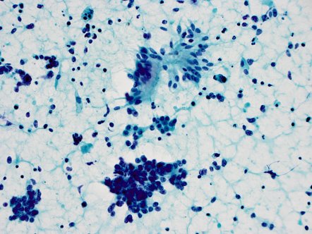 Small cell carcinoma of lung | Radiology Case | Radiopaedia.org