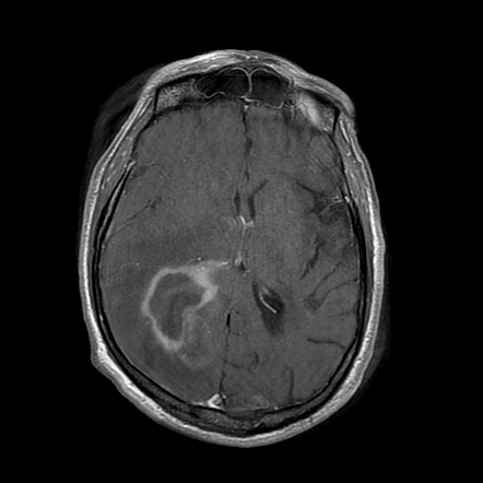 Bal Concentric Sclerosis Radiology Reference Article Radiopaedia Org