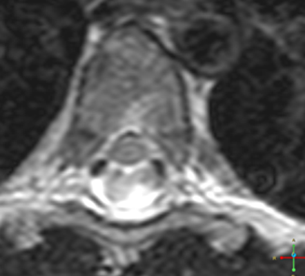 artifact csf spine radiopaedia turbulent thoracic axial