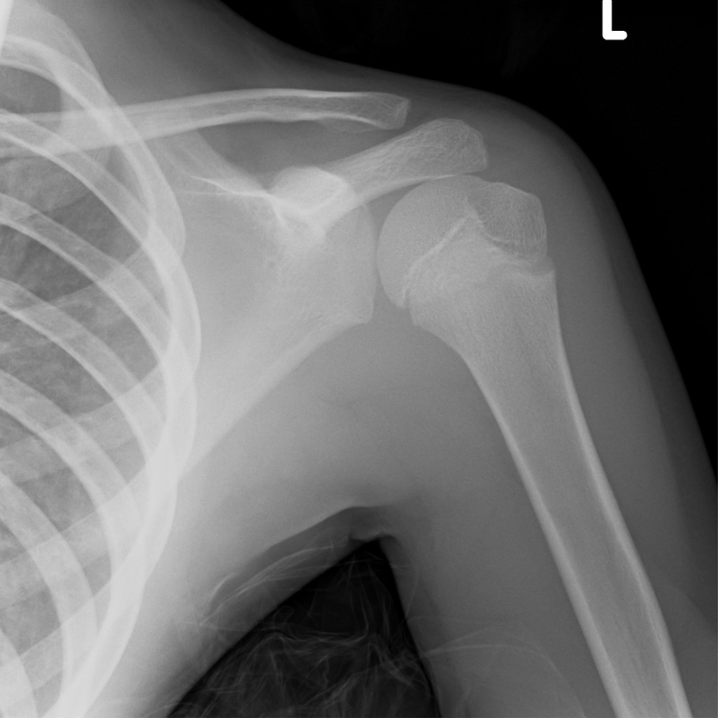 Posterior Shoulder Dislocation Radiology Case Radiopaedia Org