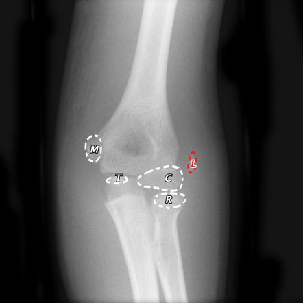 Viewing playlist: Upper limb fractures (iOS pack) | Radiopaedia.org