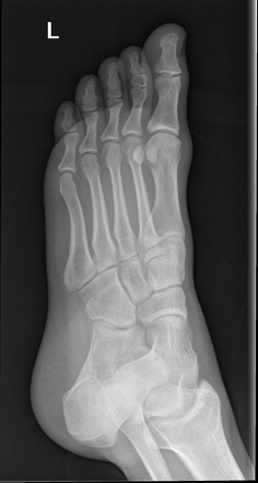 Third, fourth and fifth toe symphalangism | Image | Radiopaedia.org