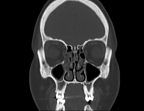 Normal CT of the orbits | Image | Radiopaedia.org