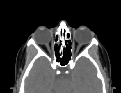 Normal CT scan of the orbits | Image | Radiopaedia.org