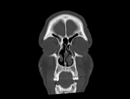 Calcified acne lesions-miliary osteoma cutis | Image | Radiopaedia.org