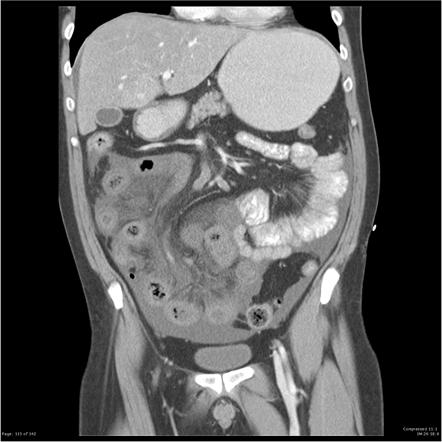 Mesenteric ischemia | Radiology Reference Article | Radiopaedia.org