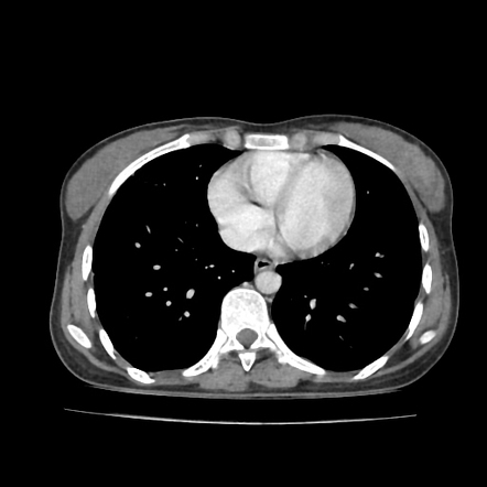 Thoracic empyema (encysted) | Image | Radiopaedia.org