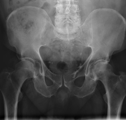 Osteoarthritis of hip | Radiology Case | Radiopaedia.org