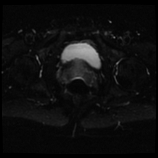 T3 Prostate Cancer Mri Image