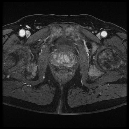 Prostate Cancer (summary) 