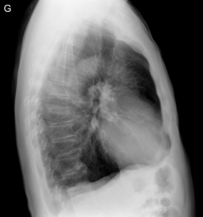 Adenocarcinoma of the lung | Image | Radiopaedia.org