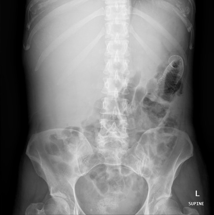 Colonic self-expandable metal stent | Image | Radiopaedia.org