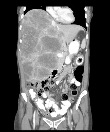 Colonic self-expandable metal stent | Image | Radiopaedia.org