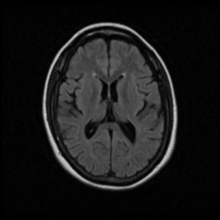 White and gray matter alterations in adults with Niemann-Pick