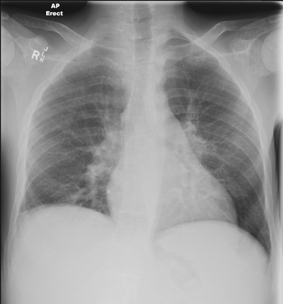 Thalassemia major | Radiology Case | Radiopaedia.org