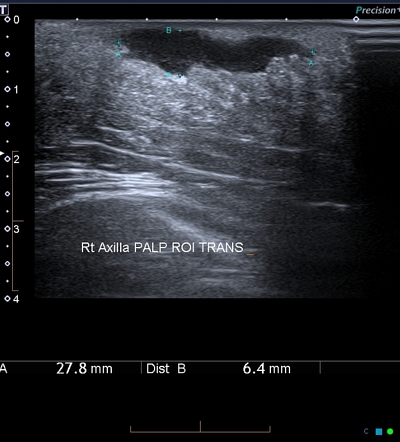 Hidradenitis Suppurativa Stage 3