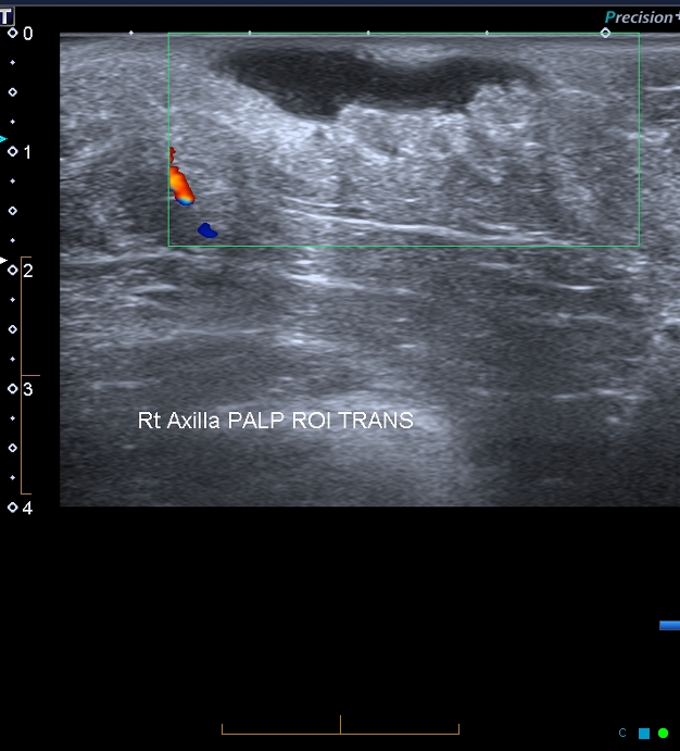 Hidradenitis Suppurativa | Image | Radiopaedia.org