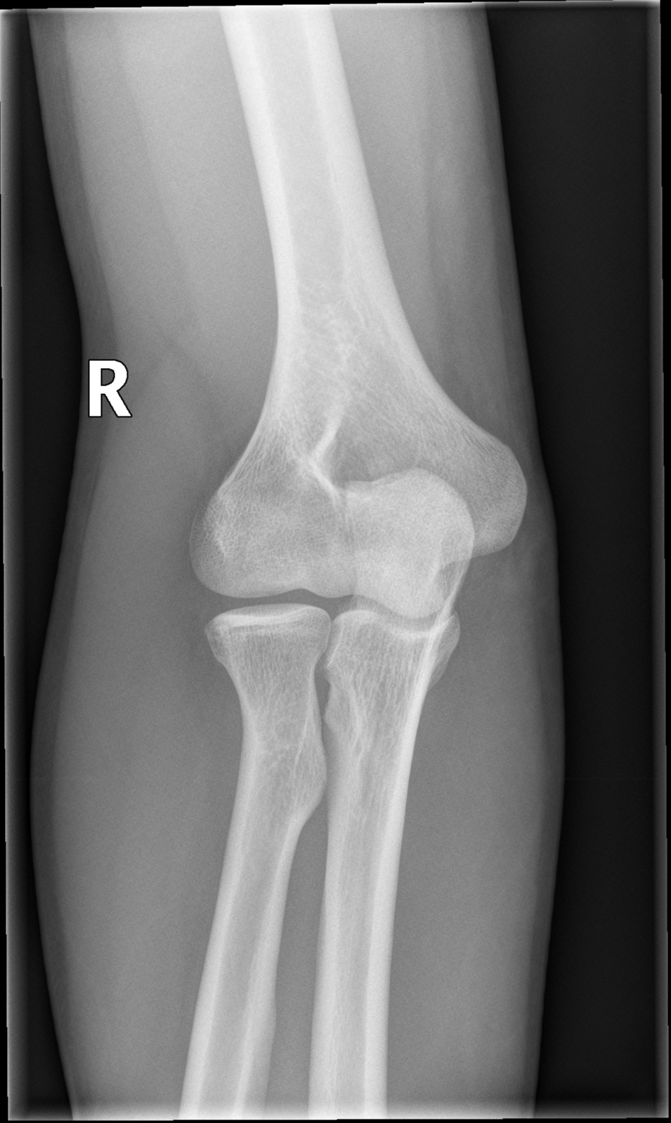 Elbow X Ray Ap