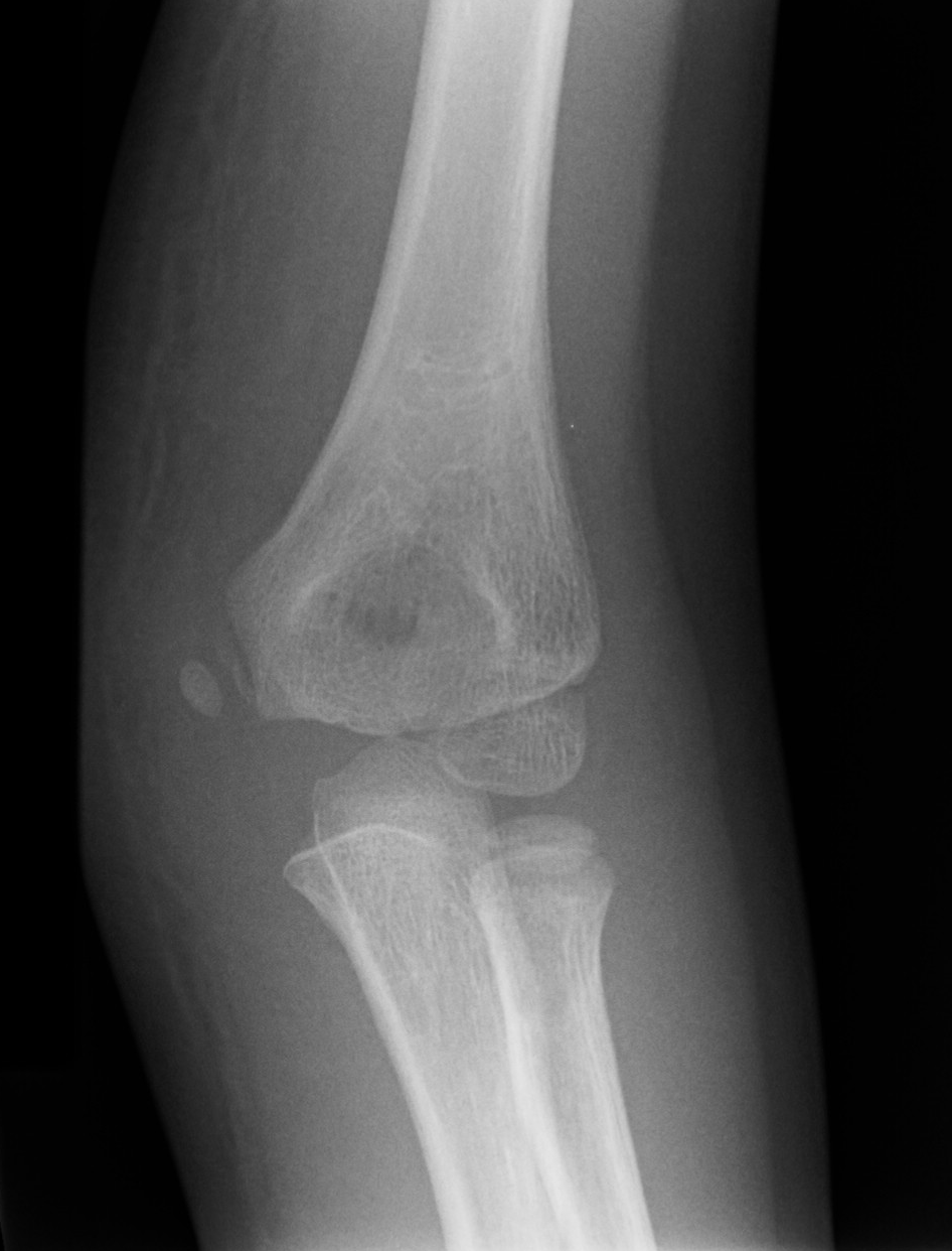 Internal epicondyle avulsion | Image | Radiopaedia.org